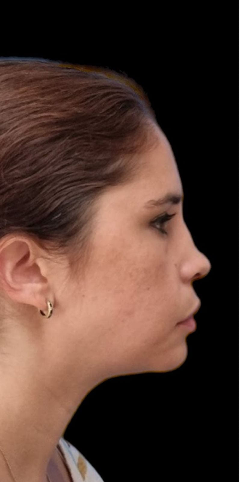 Rinoplastia — antes