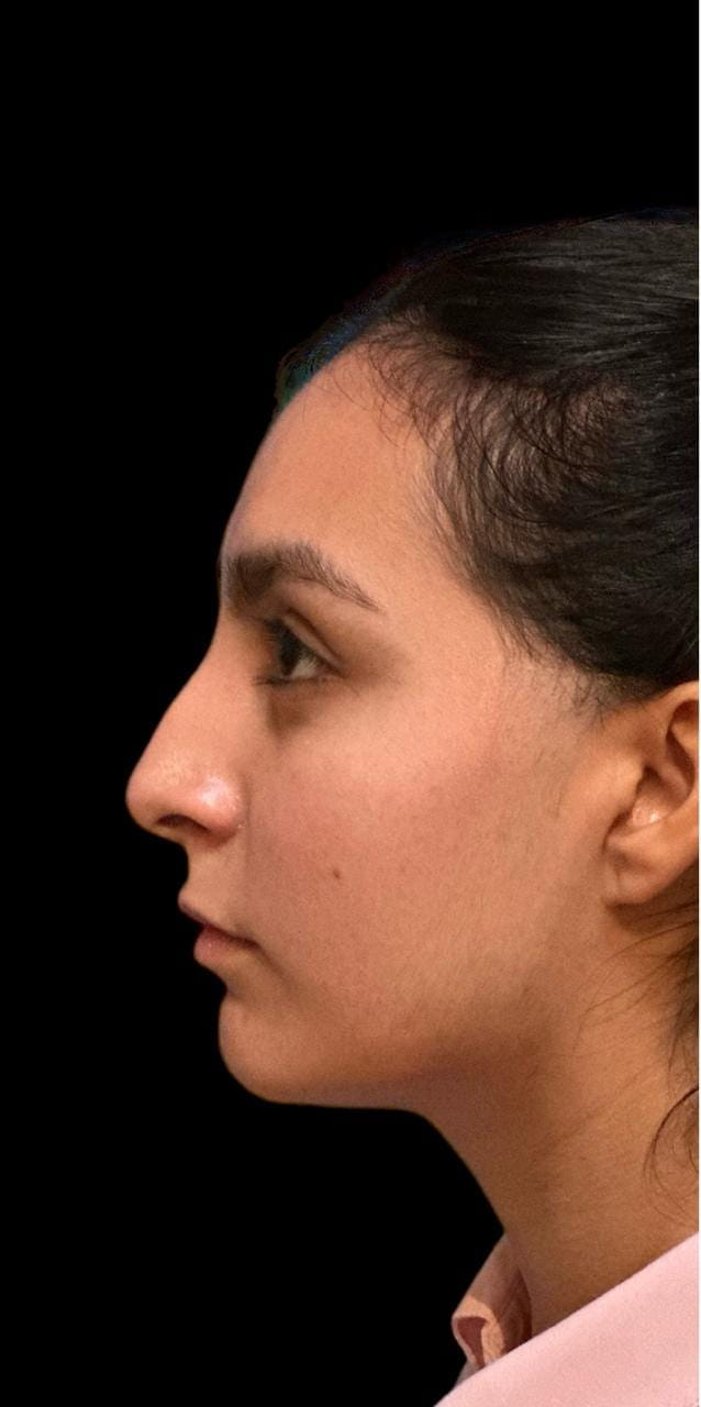 Rinoplastia — antes