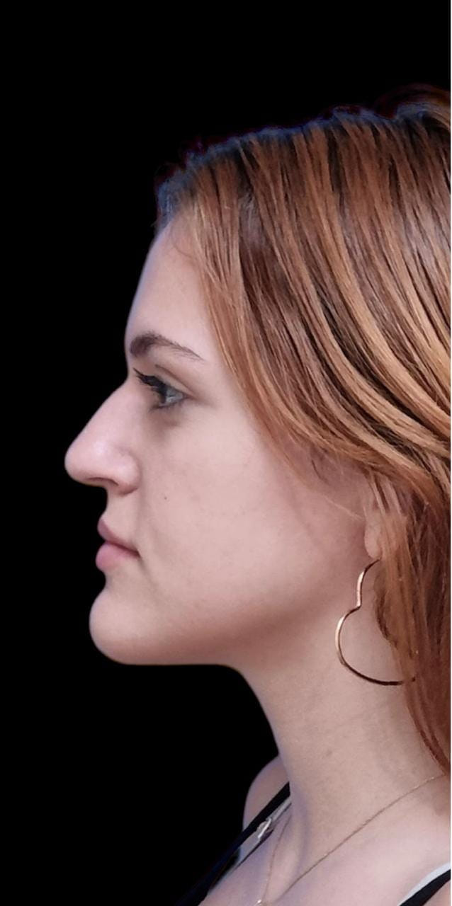 Rinoplastia — antes