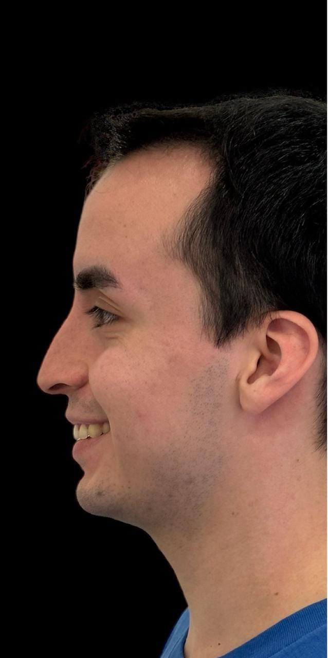 Rinoplastia — antes
