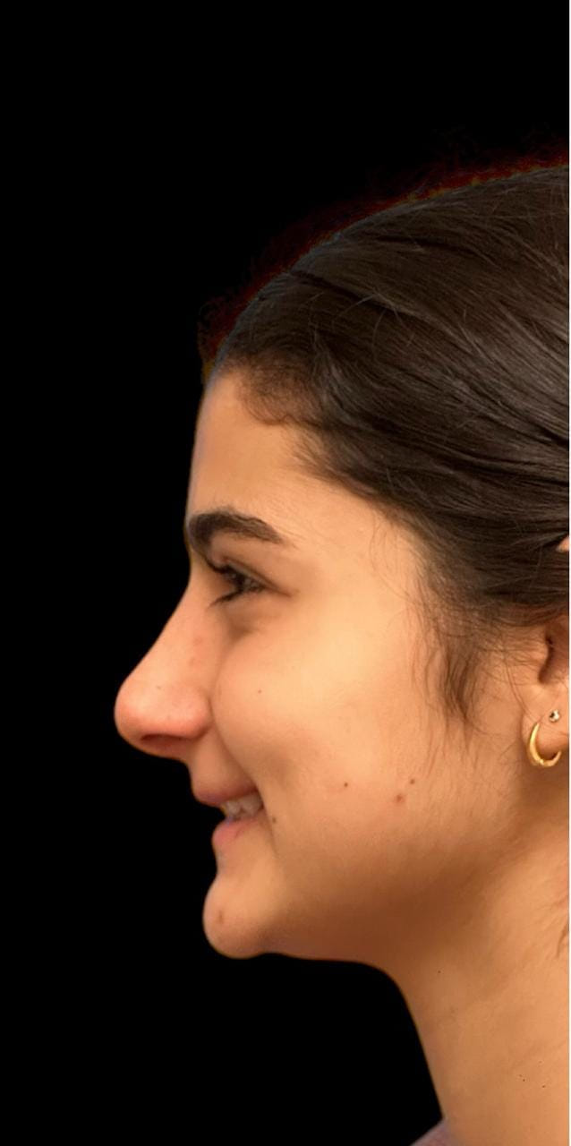 Rinoplastia — antes