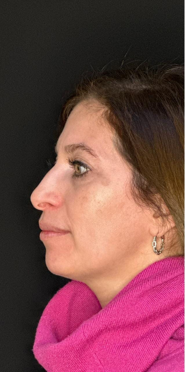 Rinoplastia — antes