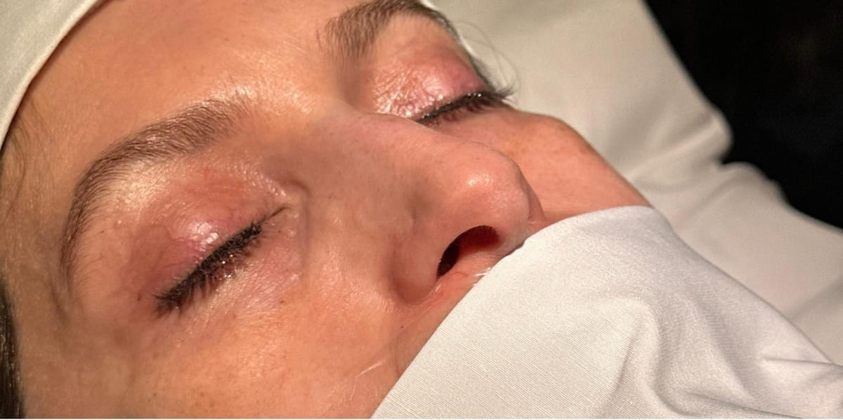 Rinoplastia — antes