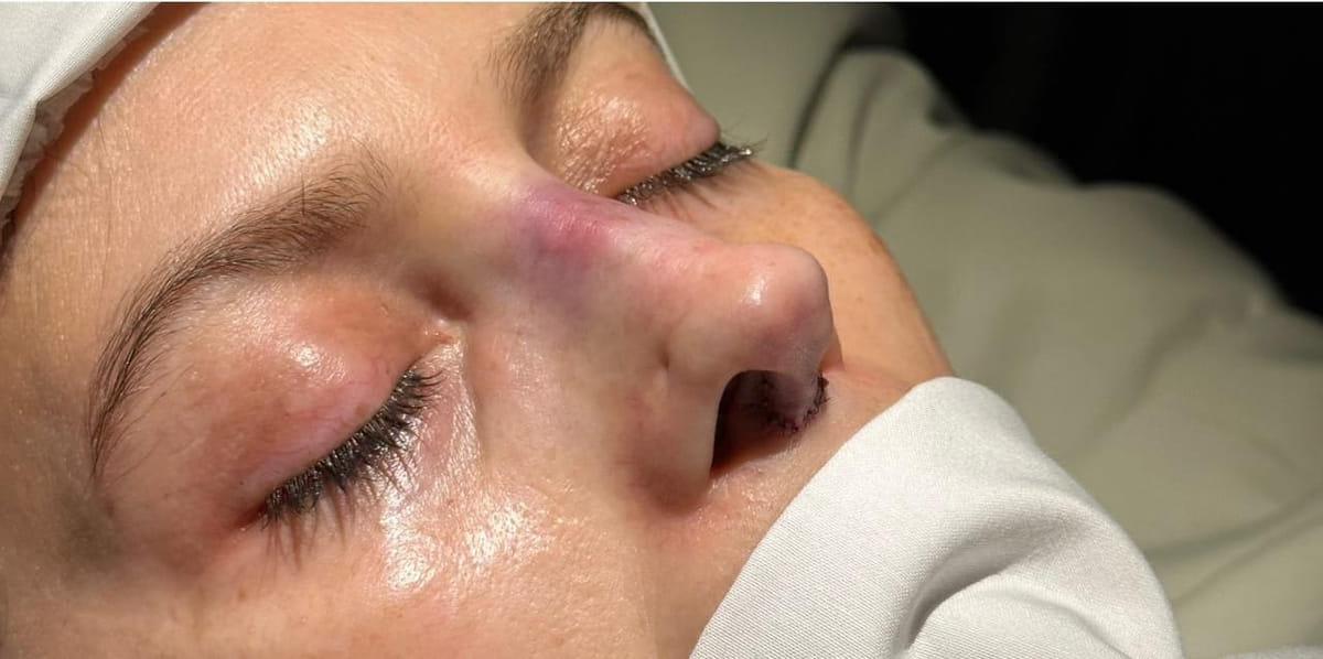 Rinoplastia — después